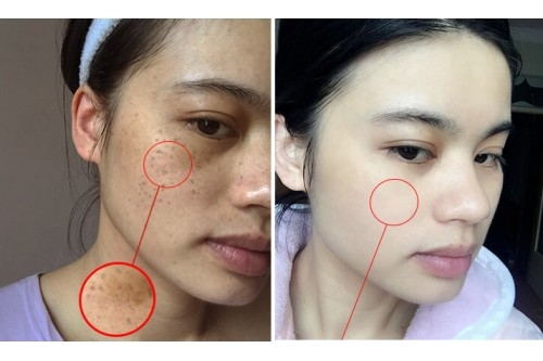 CÁC CÁCH TRỊ NÁM VÀ TÀN NHANG