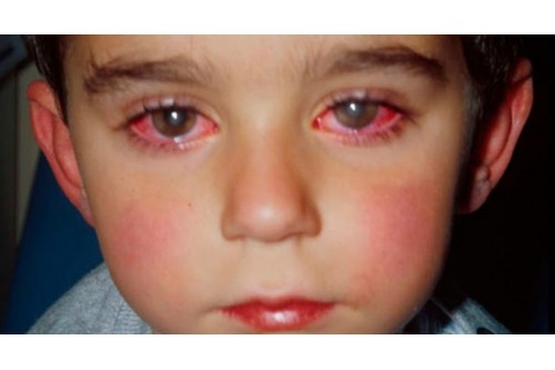 Cách chữa mắt nhìn một hóa hai