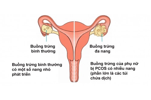 Chữa bệnh Đa nang, u nang buồng trứng và vô sinh nữ
