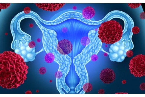 Chữa bệnh Đa nang, u nang buồng trứng và vô sinh nữ