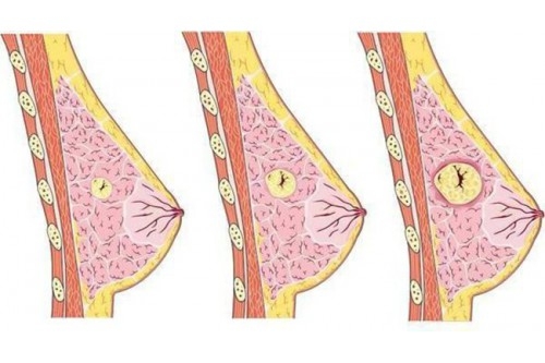 Chữa bệnh U xơ tuyến vú như thế nào là An toàn?