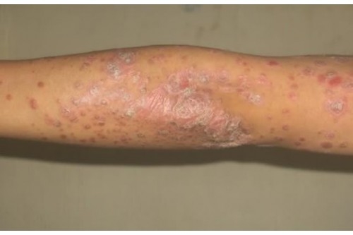 Điều trị bệnh vẩy nến,á sừng,gầu