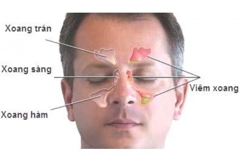 Điều trị viêm xoang bằng bấm huyệt
