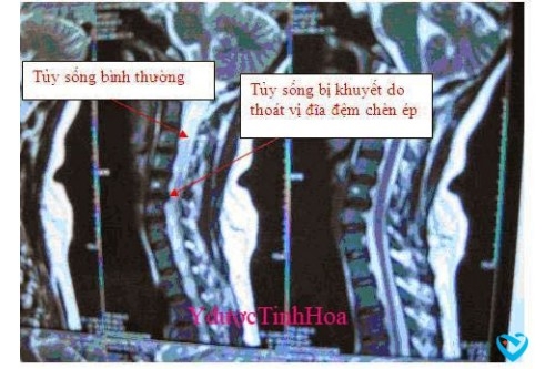 Gai cột sống và phương pháp điều trị tận gốc