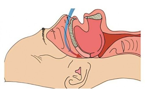 Hội chứng ngưng thở khi ngủ