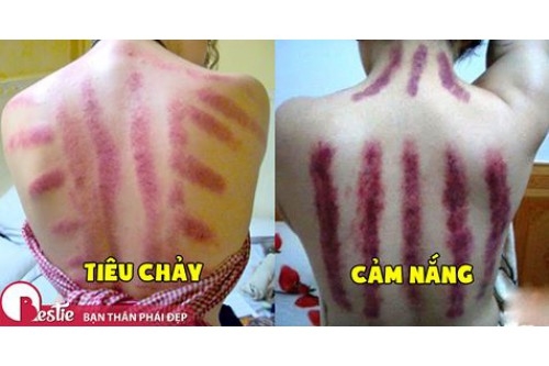 MÁCH BẠN 5 CÁCH CẠO GIÓ CHUẨN CHO TỪNG LOẠI BỆNH