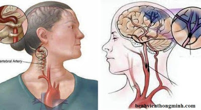 Tai biến mạch máu não và cách chữa hiệu quả