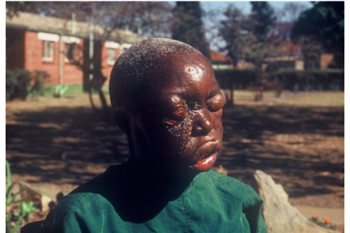 Tổ chức Y tế Thế giới vừa đưa ra khuyến cáo về tình trạng của đại dịch Ebola, đó là: Ngoài tầm kiểm soát.