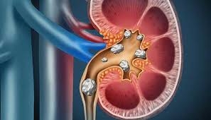 Tôi bị sỏi thận 