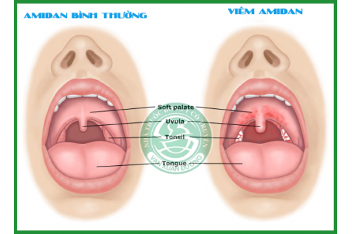 Trị bệnh Amidan tận gốc