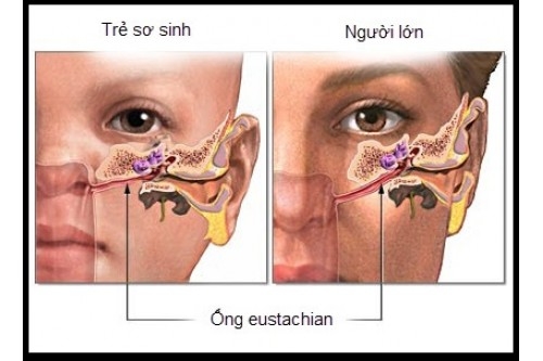 Viêm tai giữa cấp là gì